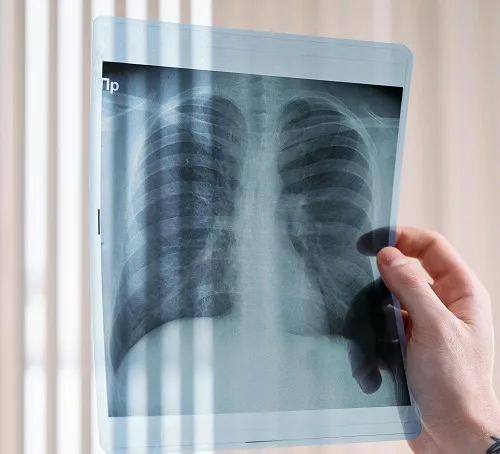 Tumore del polmone e fumo, segnali positivi per le donne in UE