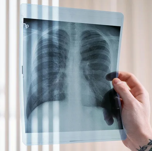 BPCO: il fumo di sigaretta responsabile del 70% della mortalità