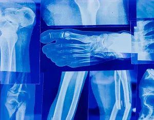 Salute femminile: giovani ossa a rischio per colpa delle sigarette